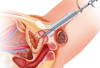 Cistocopia com biopsia